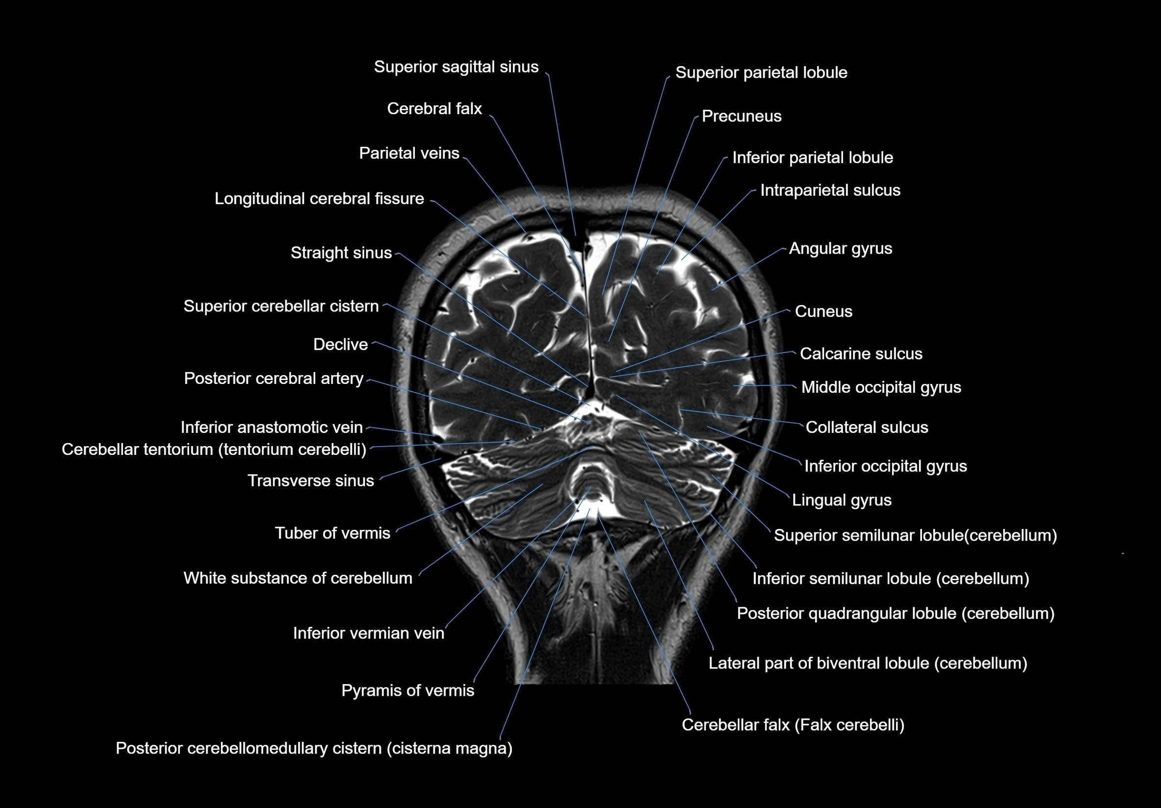 MRI Brain coronal cross sectional labelled anatomy 3T image  -img-00001-00060.webp